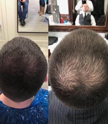 Before-After-Scalp-Pigmentation-at-Mova-Hair-Loss-Salon-Staines