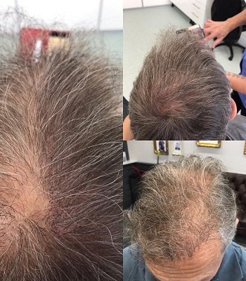Hair-loss-treatments-scalp-pigmentation-mova-hairdressers-staines