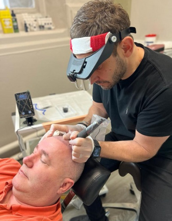 Scalp-Pigmentation-for-Baldness-in-Staines