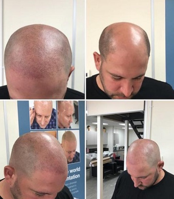 Scalp-micropigmentation-at-Mova-hair-loss-salon-in-staines-upon-thames