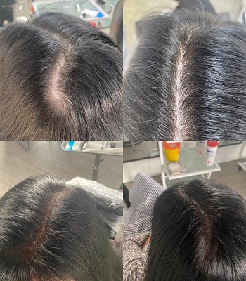 before-after-scalp-pigmentation-for-women-in-Staines