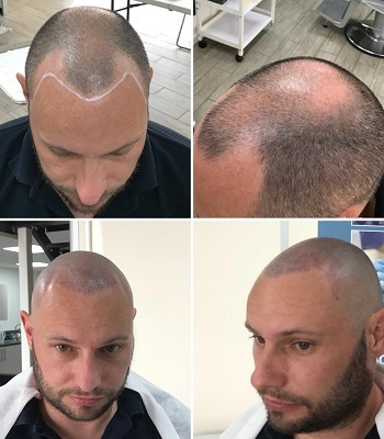 scalp-pigmentation-at-mova-hair-salon-in-staines-upon-thames