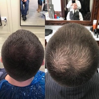Before-After-Scalp-Pigmentation-at-Mova-Hair-Loss-Salon-Staines