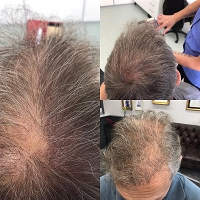 Hair-loss-treatments-scalp-pigmentation-mova-hairdressers-staines