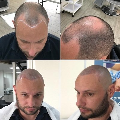 scalp-pigmentation-at-mova-hair-salon-in-staines-upon-thames